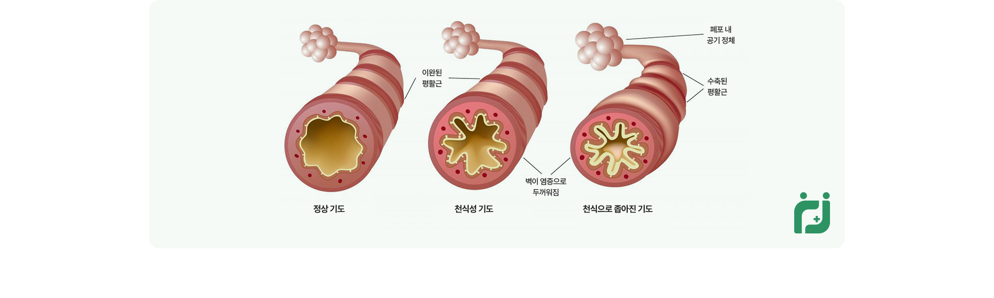 증상이 좋아졌다가도 다시 나타날 수 있어 유발 요인을 함께 확인하고 꾸준히 관리하는 것이 필요합니다.