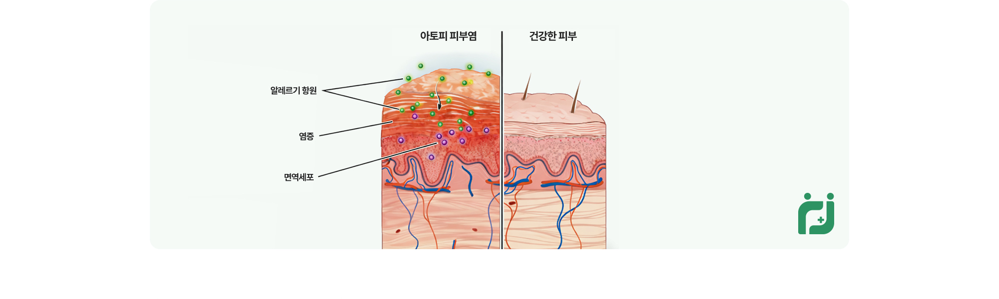 유전적인 요인과 환경적인 요인에 의해 발병하는 것으로 알려져 있는데 적절히 외부요인을 조절하는 경우 상당한 효과를 볼 수 있습니다. 특히 피부에 자극을 주는 요인은 무조건 피하는 것이 좋습니다.