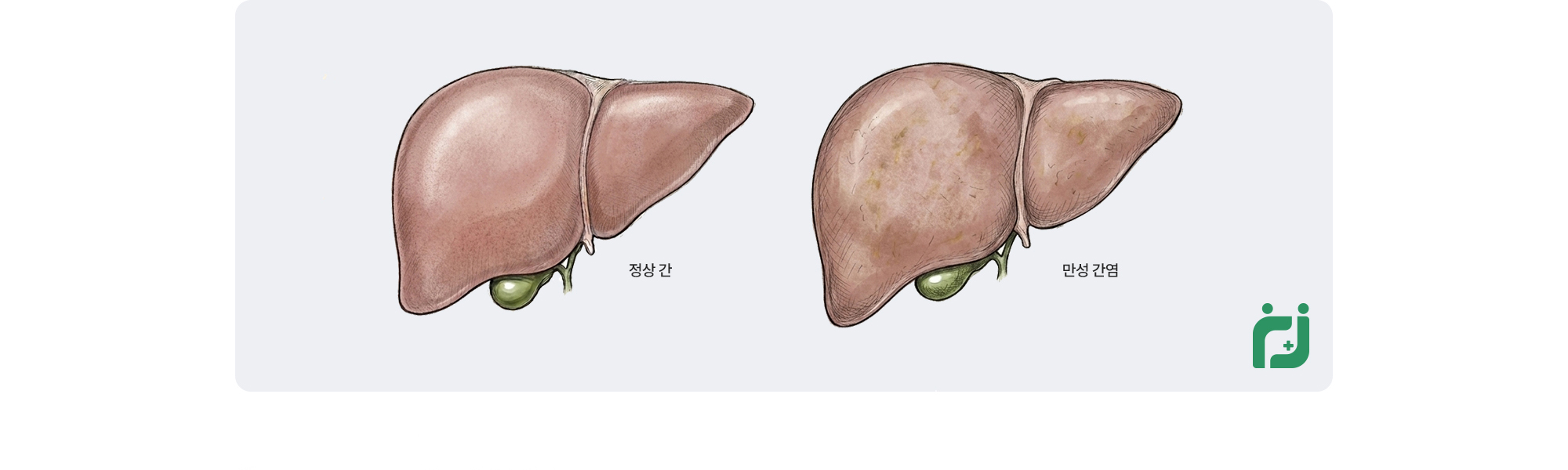 원인은 B형·C형 간염 바이러스, 지방간, 음주, 약물 등으로 다양하며 그 중 B형 만성 간염은 B형 간염 바이러스가 몸에 남아 염증이 반복될 수 있어 정기적인 수치 확인과 추적 관리가 필요합니다.