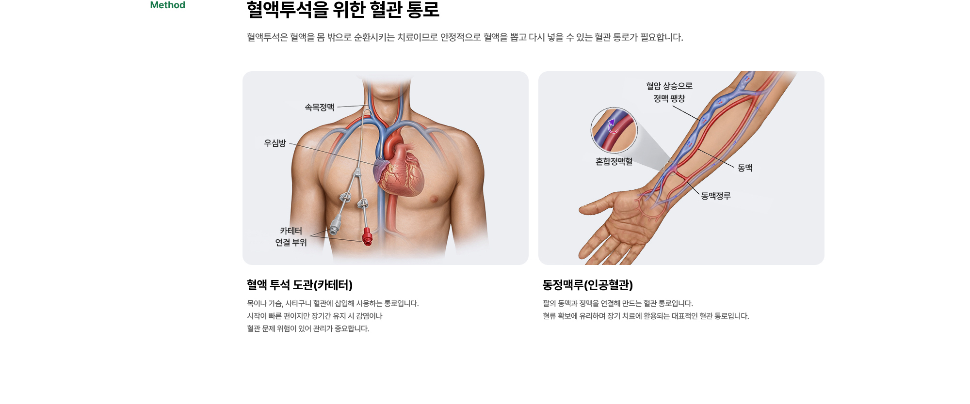 혈액투석을 위한 혈관 통로 혈액투석은 혈액을 몸 밖으로 순환시키는 치료이므로 안정적으로 혈액을 뽑고 다시 넣을 수 있는 혈관 통로가 필요합니다.